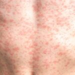 Tourist May Have Exposed Hundreds of Thousands in San Antonio to Measles, Health Experts Warn