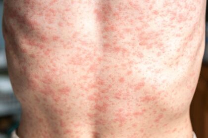 Tourist May Have Exposed Hundreds of Thousands in San Antonio to Measles, Health Experts Warn