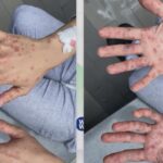 Monkeypox Cases Rise to 5 in San Antonio as Education Efforts Kick Off