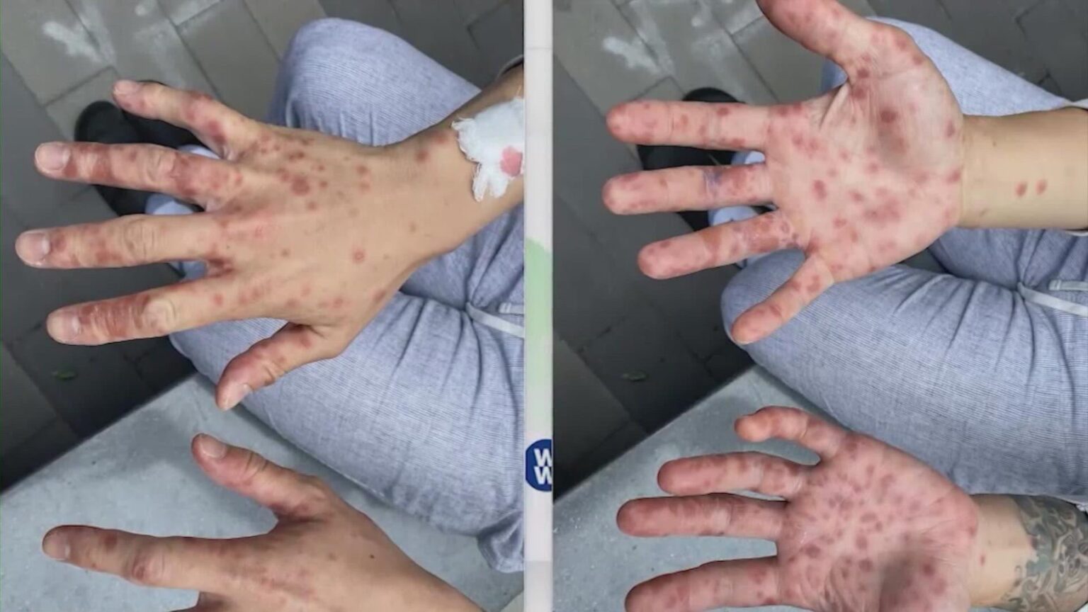 Monkeypox Cases Rise to 5 in San Antonio as Education Efforts Kick Off Monkeypox Cases Rise to 5 in San Antonio as Education Efforts Kick Off