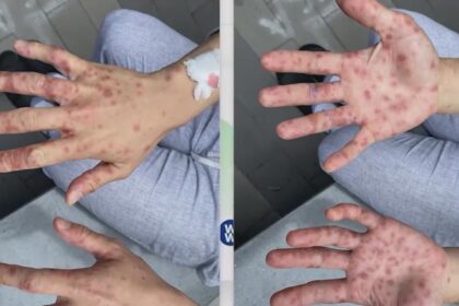 Monkeypox Cases Rise to 5 in San Antonio as Education Efforts Kick Off