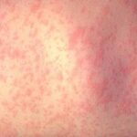 San Diego Health Officials Urge Spring Breakers to Stay Vigilant Against Measles