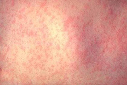 San Diego Health Officials Urge Spring Breakers to Stay Vigilant Against Measles