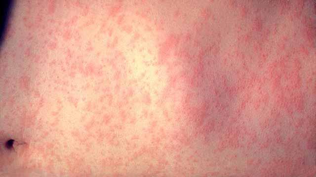 San Diego Health Officials Urge Spring Breakers to Stay Vigilant Against Measles San Diego Health Officials Urge Spring Breakers to Stay Vigilant Against Measles