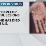 Monkeypox Cases Rise to 5 in San Antonio as Education Efforts Kick Off