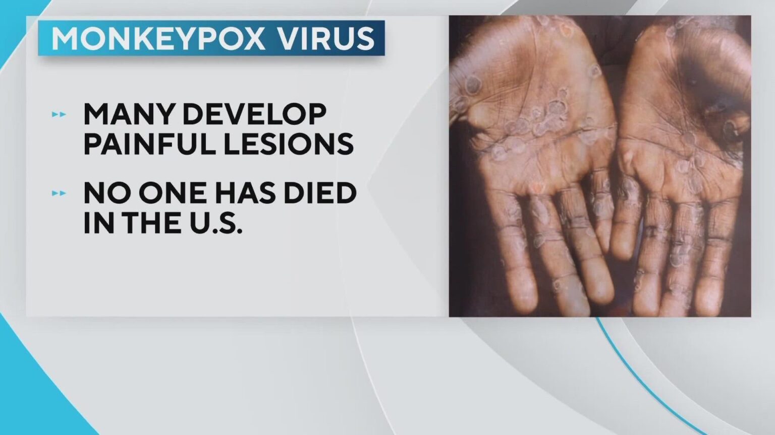 Monkeypox Cases Rise to 5 in San Antonio as Education Efforts Kick Off