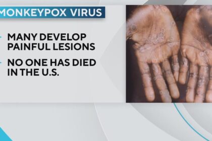 Monkeypox Cases Rise to 5 in San Antonio as Education Efforts Kick Off